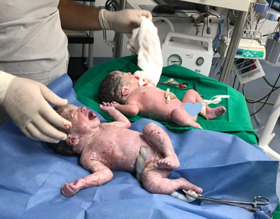 Atención y adaptación neonatal de gemelos recién nacidos por parto múltiple en sala de partos.